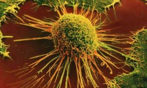 cancer cells 300x180 When the Diagnosis is Cancer