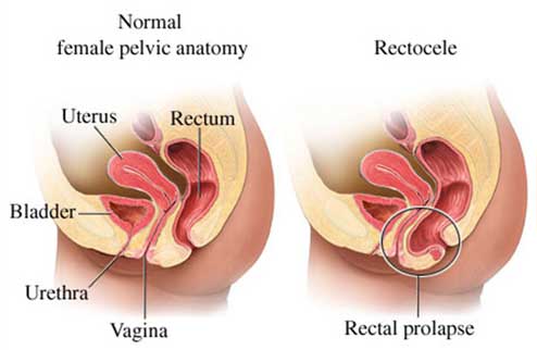 rectocele-anatomy